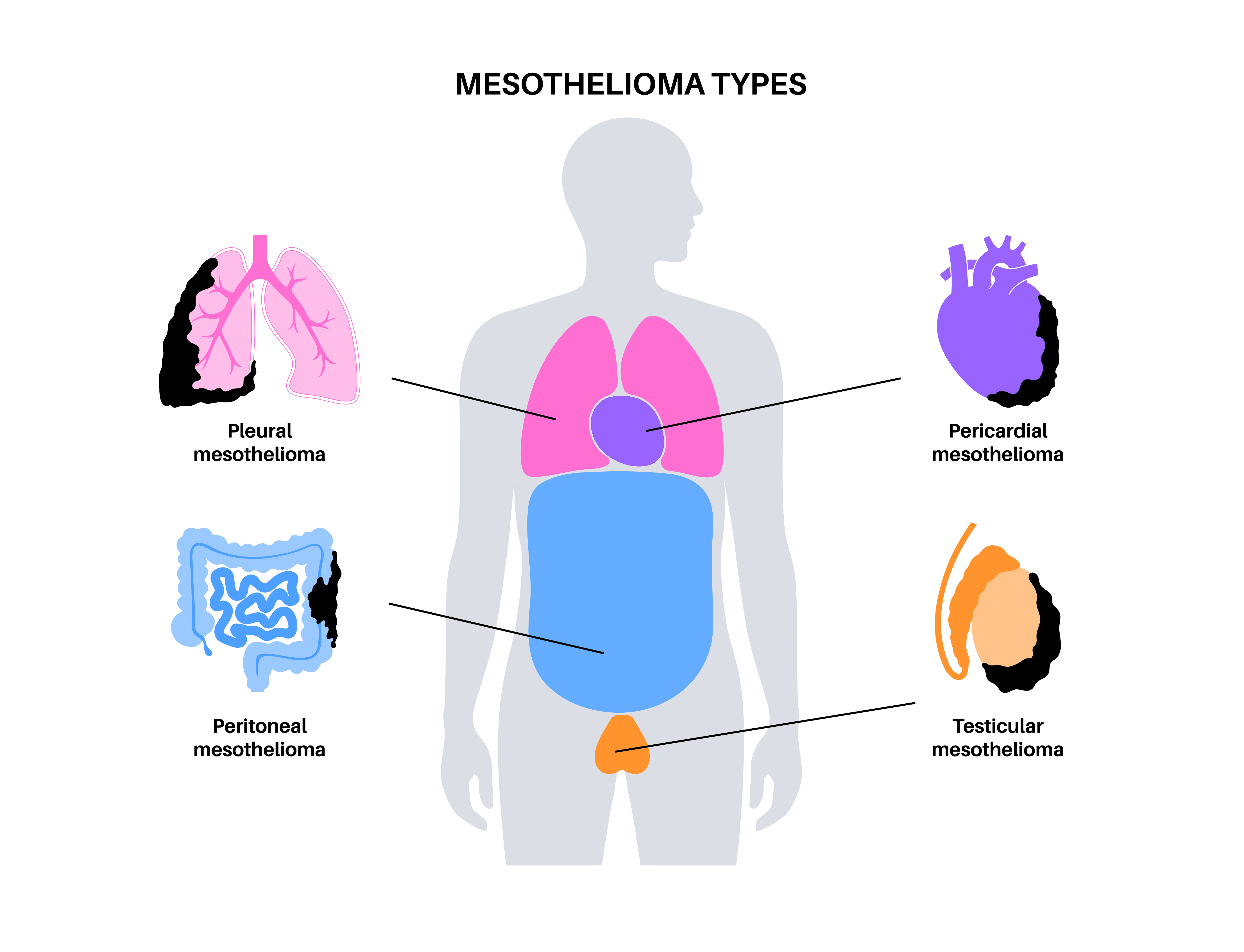 An infographic displaying the types of mesothelioma.