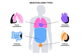 An infographic displaying the types of mesothelioma.